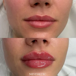 pierwsza fotografia przedstawiająca efekty przed i po zabiegu powiększania ust