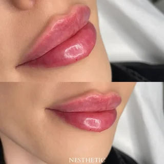 trzecia fotografia przedstawiająca efekty przed i po zabiegu powiększania ust