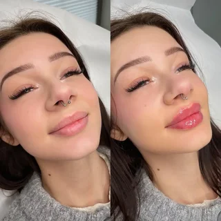 druga fotografia przedstawiająca efekty przed i po zabiegu powiększania ust